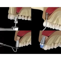 Xcem Osspore Bone Grafts For Sinus