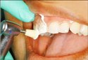 Scaling And Polishing Service