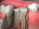 Post And Cores Service