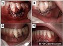 Gum Surgeries Treatment