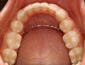 Braces And Retainers Service