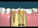 Root canal treatment