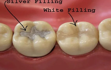 Fillings Service