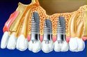 Dental Implants Service