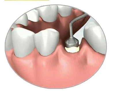 Bone Grafting Service