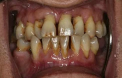 Gum Treatment