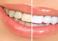 Teeth Bleaching