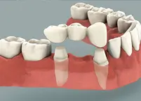 Crowns & Bridges